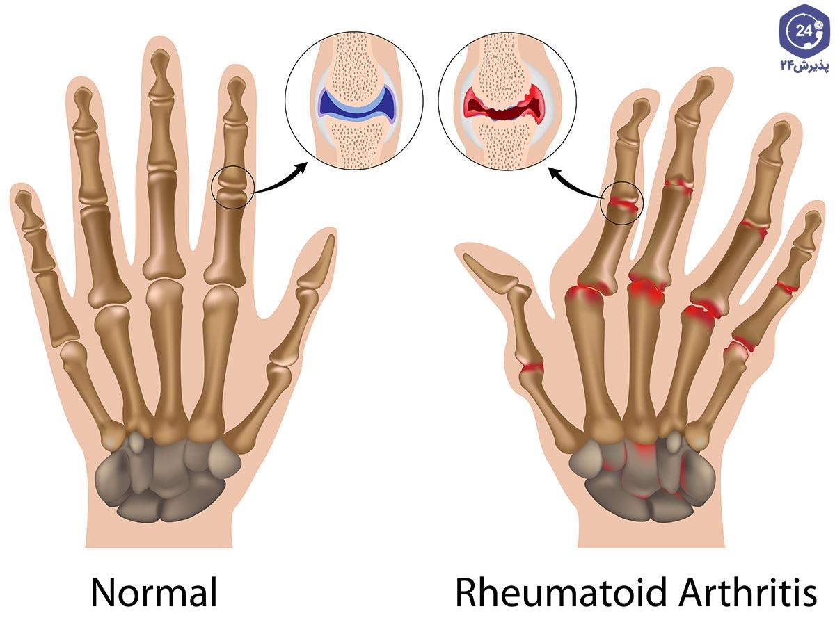 تفاوت ام‌ اس و روماتیسم مفصلی